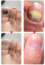 Charger l'image dans la galerie, BJ-Mooyam-Traitement anti-mycoses des ongles

