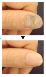 Charger l'image dans la galerie, BJ-Mooyam-Traitement anti-mycoses des ongles
